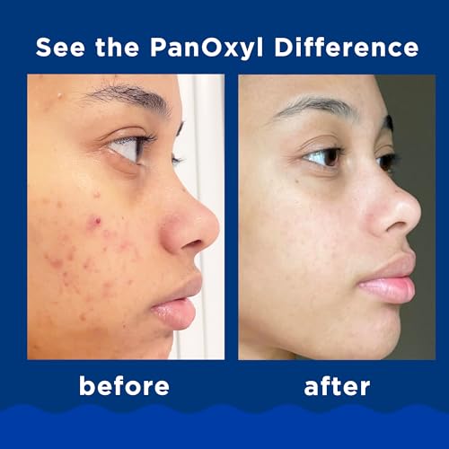 PanOxyl 10%  Acne Washing Foam