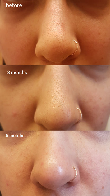 Salicylic Acid 2% Masque
