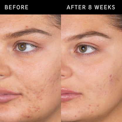 Salicylic Acid 2% Masque