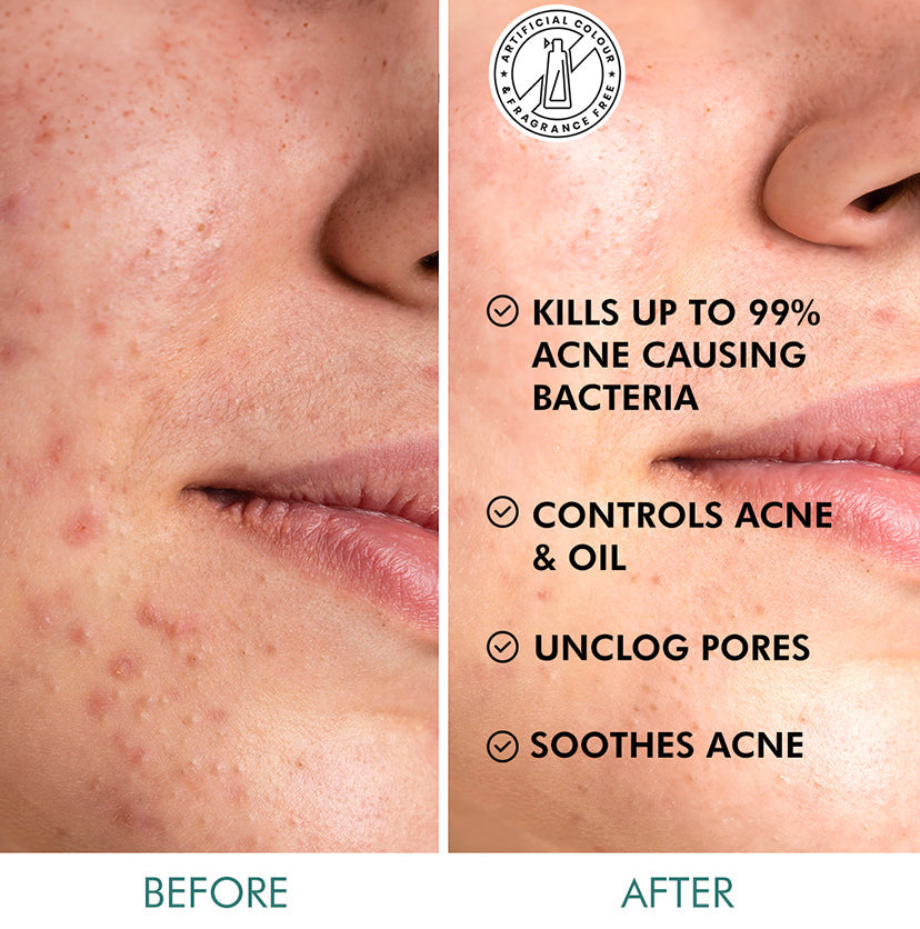 Salicylic Acid 2% Masque